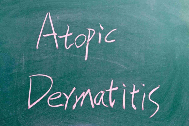 atopijski-dermatitis-druge-kožne-bolesti