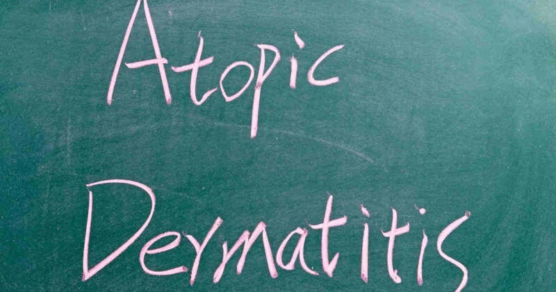 Atopijski dermatitis: Kako razlikovati od drugih kožnih bolesti?